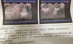 治疗多囊卵巢的最佳方法是什么？ 多囊卵巢怎么治最好