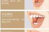 牙贴面能维持多久 牙贴面大概可以维持多久