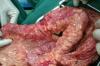 肠息肉治疗方法 结肠息肉怎么治疗
