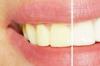 美白牙齿窍门 怎样可以美白牙齿?